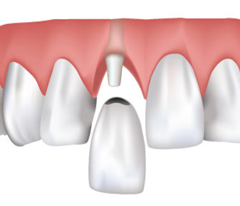 Drs. Shires and Schmidt Offer Dental Crowns