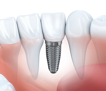 Drs. Shires and Schmidt Offer Dental Implants