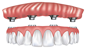 Drs. Schmidt and Shires Offer Implant Supported Dentures